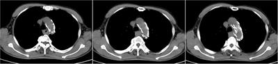 Case report: A case of rectal metastatic squamous cell carcinoma from the esophagus